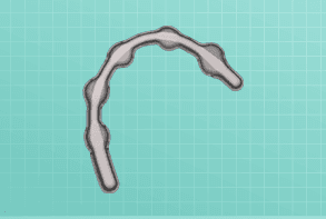 Fixed dental prosthesis showing a ceramic bridge restoration