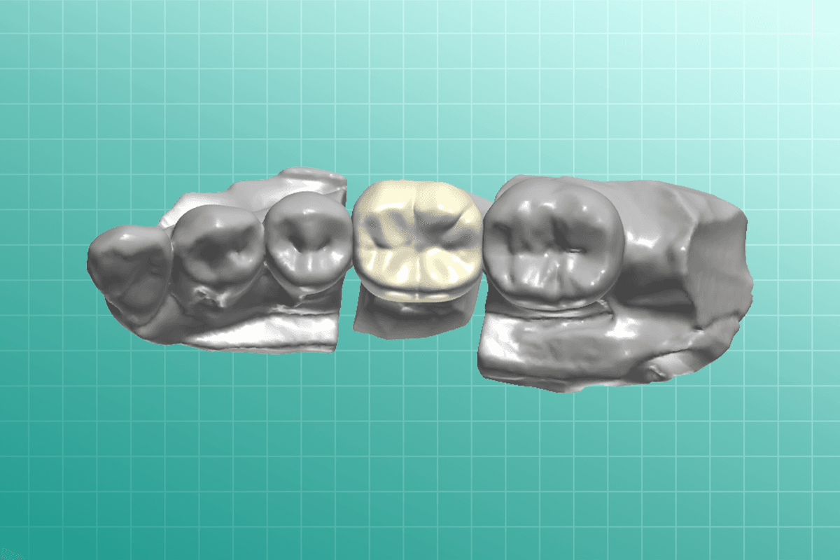 Fixed dental prosthesis showing a ceramic bridge restoration