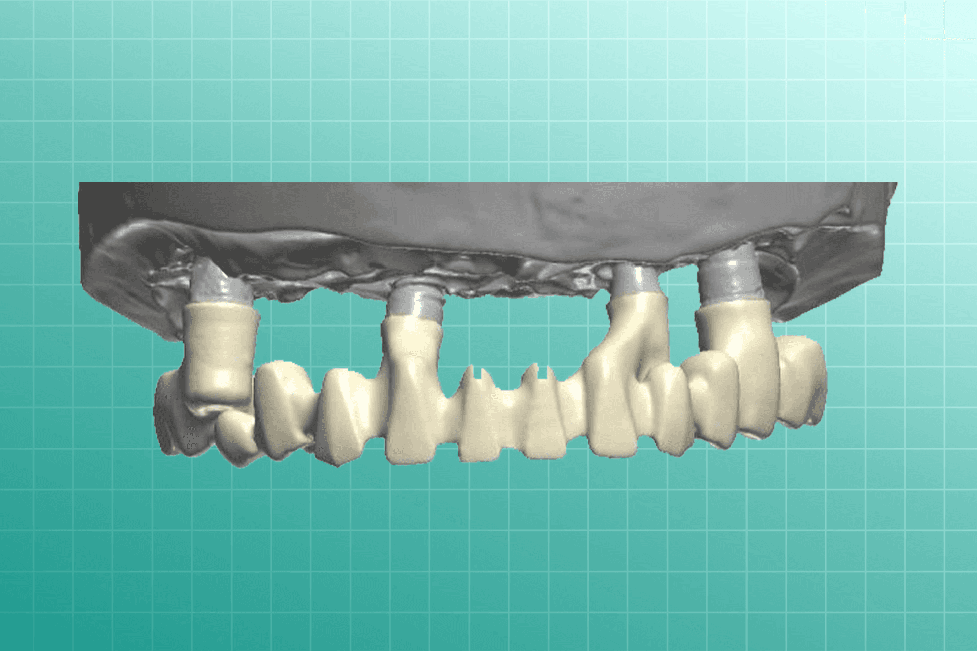 Anatomical Coping dental prosthesis