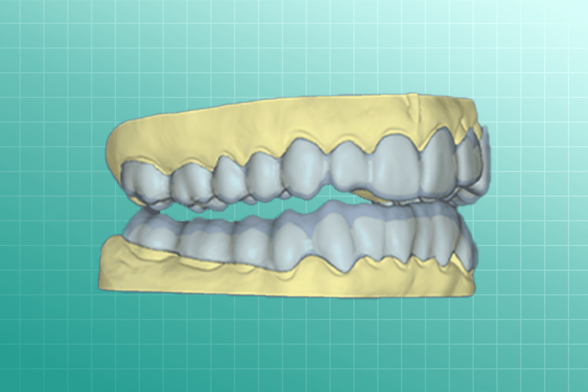 Mouth Guards dental prosthesis