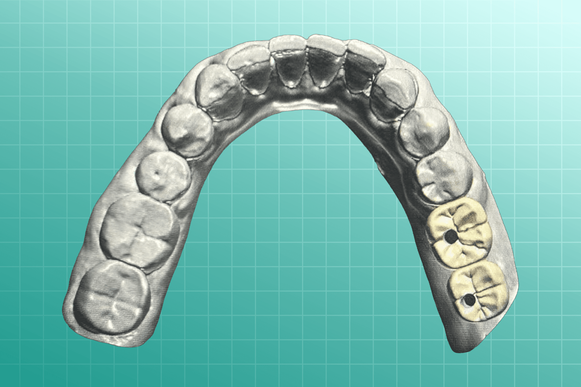 Screw-Retained dental prosthesis
