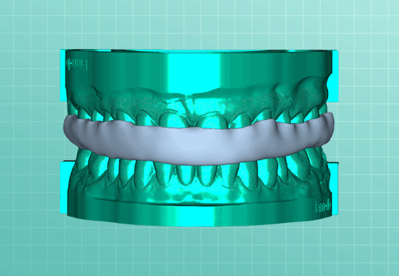Fixed dental prosthesis showing a ceramic bridge restoration