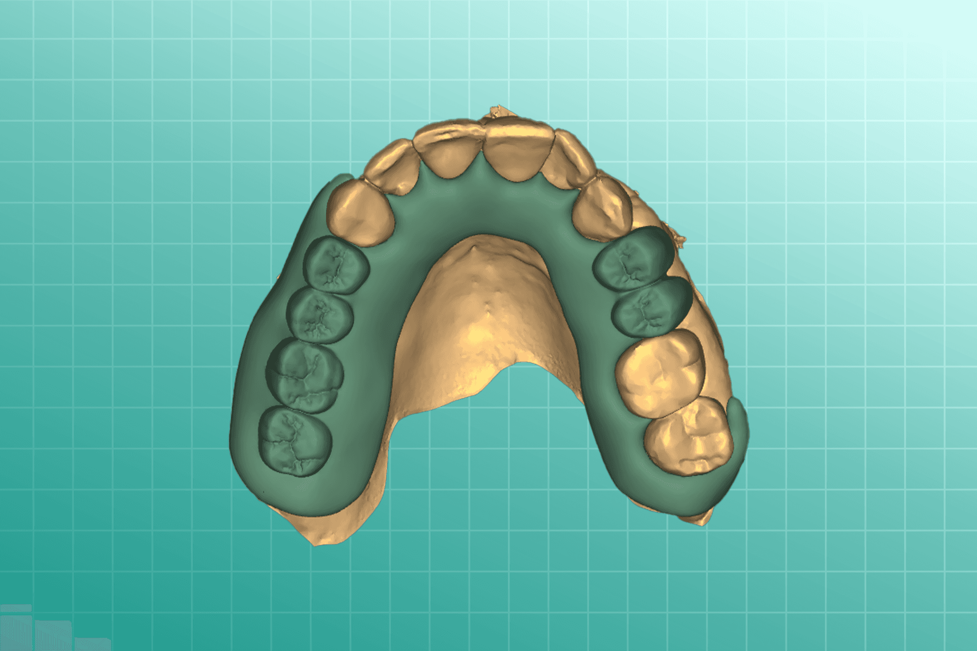 Flexible Partial Dentures(FPD) dental prosthesis